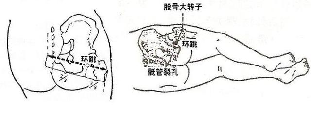 推拿可以调理坐骨神经痛吗？如何操作？