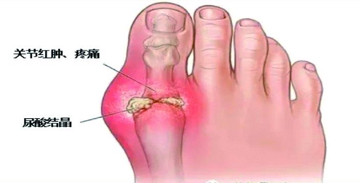 痛风如何治疗？推荐几个中医方法