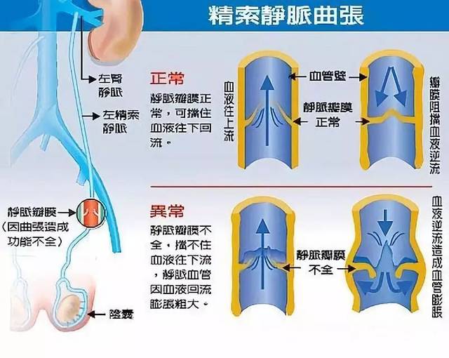 对于精索静脉曲张 中医推荐3个疗法