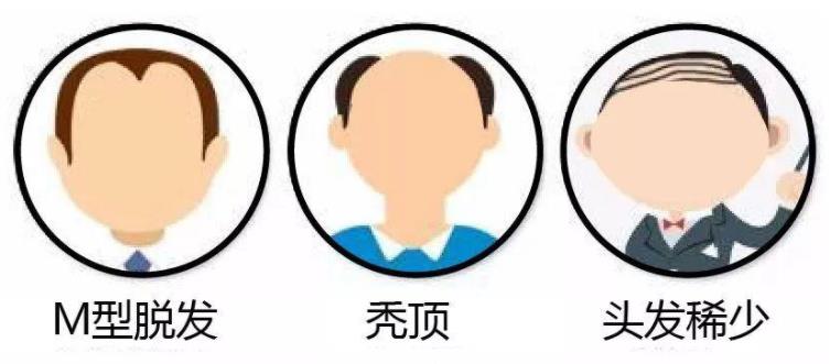 你有脱发困扰吗？推拿按摩帮你治脱发